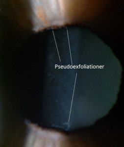 Pseudoexfoliationer