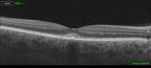 OCT vitelliform maculopati